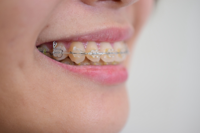 中村歯科コラム：矯正治療で歯列が整う
