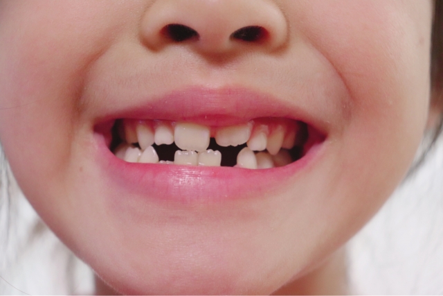 中村歯科コラム：乳歯は虫歯に注意が必要です