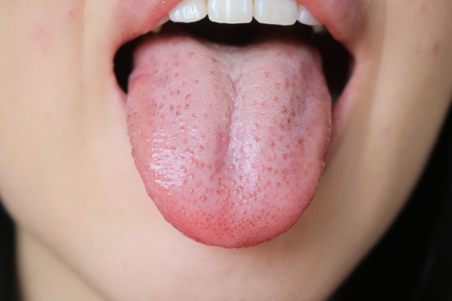 舌苔の原因は？